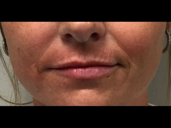 Filler Injections for Face Before & After Gallery - Patient 16689059 - Image 1