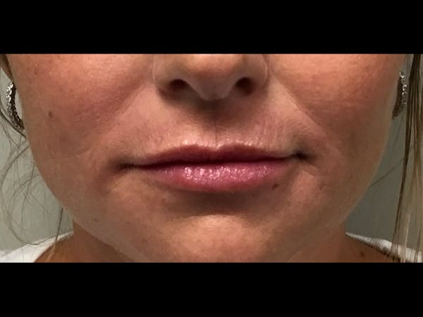 Filler Injections for Face Before & After Gallery - Patient 16689059 - Image 2