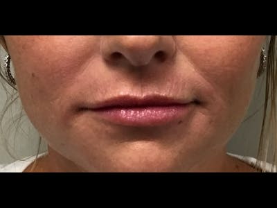 Filler Injections for Face Before & After Gallery - Patient 16689059 - Image 2