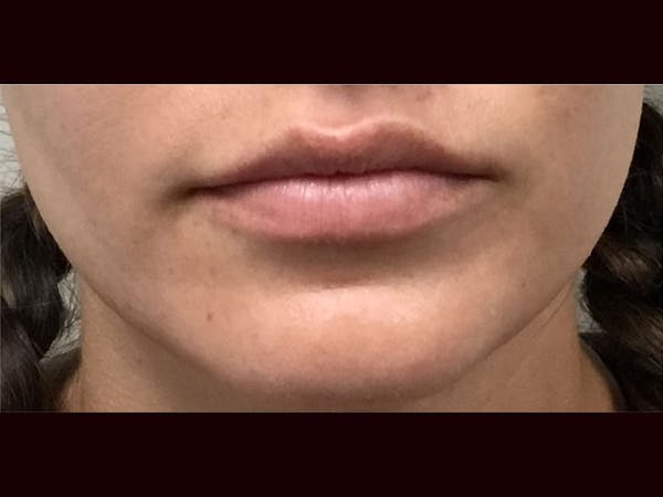 Filler Injections for Face Before & After Gallery - Patient 16689062 - Image 1