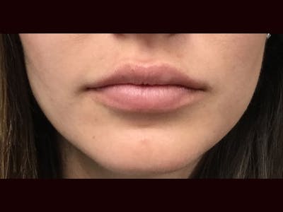 Filler Injections for Face Before & After Gallery - Patient 16689062 - Image 2