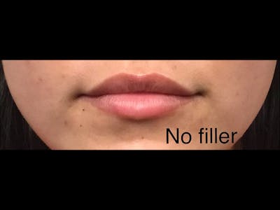 Filler Injections for Face Before & After Gallery - Patient 16689063 - Image 1