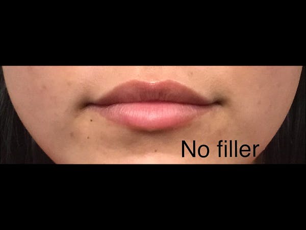 Filler Injections for Face Before & After Gallery - Patient 16689063 - Image 1