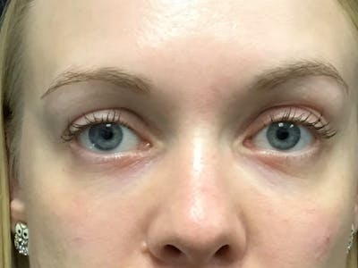 Filler Injections for Face Before & After Gallery - Patient 16689064 - Image 2