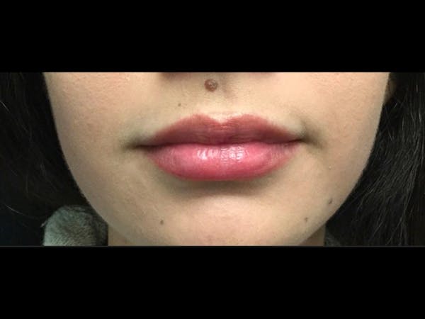 Filler Injections for Face Before & After Gallery - Patient 16689066 - Image 2
