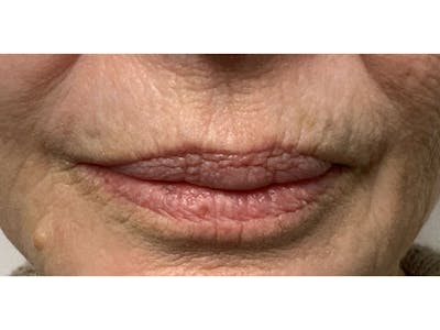 Filler Injections for Face Before & After Gallery - Patient 16689071 - Image 1