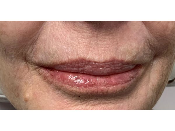 Filler Injections for Face Before & After Gallery - Patient 16689071 - Image 2