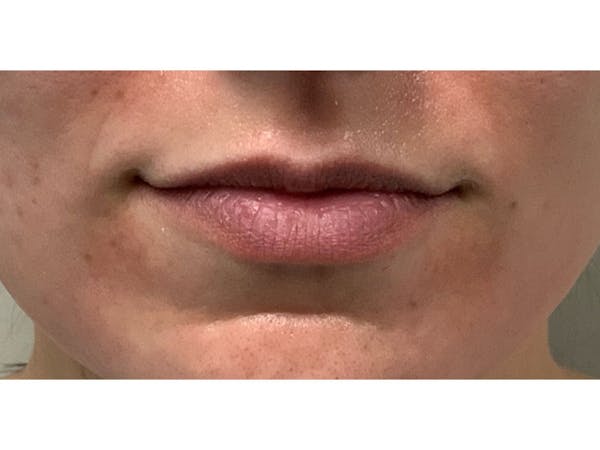 Filler Injections for Face Before & After Gallery - Patient 16689074 - Image 1