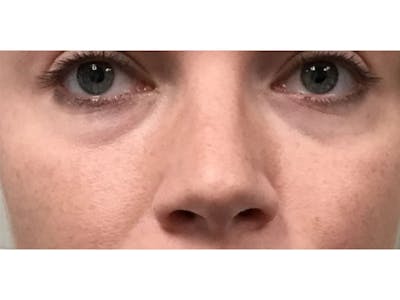 Filler Injections for Face Before & After Gallery - Patient 16689075 - Image 1