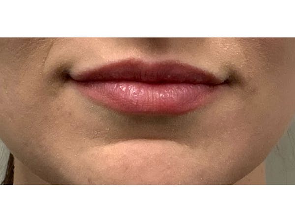 Filler Injections for Face Before & After Gallery - Patient 16689074 - Image 2
