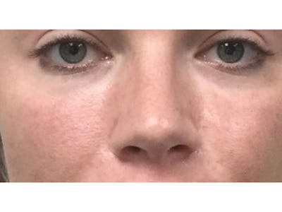 Filler Injections for Face Before & After Gallery - Patient 16689075 - Image 2