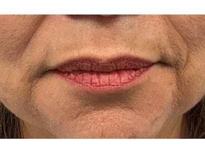 Filler Injections for Face Before & After Gallery - Patient 16689078 - Image 1