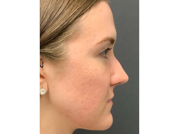 Filler Injections for Face Before & After Gallery - Patient 16689079 - Image 1