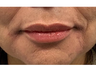 Filler Injections for Face Before & After Gallery - Patient 16689078 - Image 2