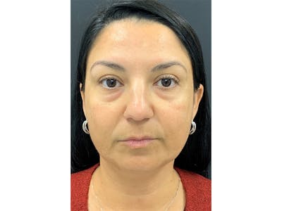 Filler Injections for Face Before & After Gallery - Patient 16689080 - Image 1