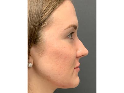 Filler Injections for Face Before & After Gallery - Patient 16689079 - Image 2
