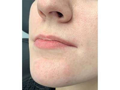 Filler Injections for Face Before & After Gallery - Patient 16689081 - Image 1