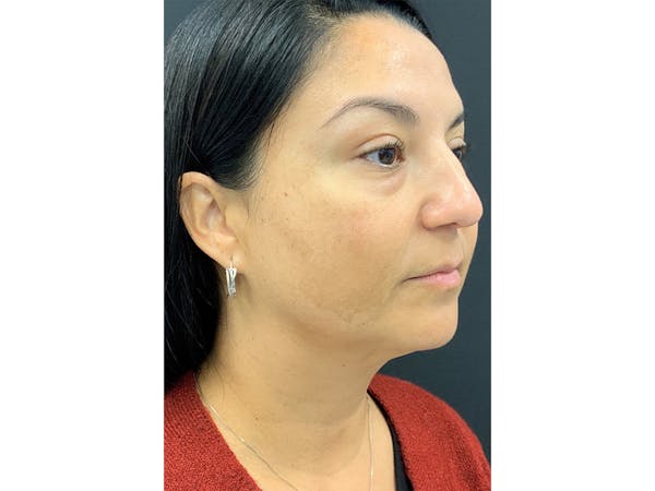 Filler Injections for Face Before & After Gallery - Patient 16689080 - Image 3
