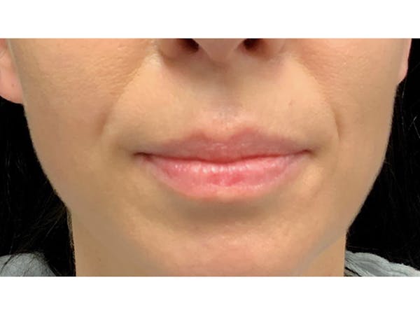 Filler Injections for Face Before & After Gallery - Patient 16689082 - Image 1