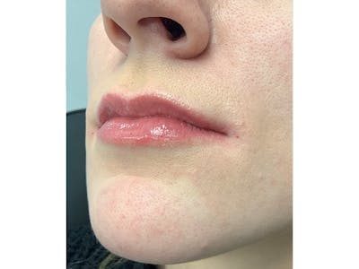 Filler Injections for Face Before & After Gallery - Patient 16689081 - Image 2