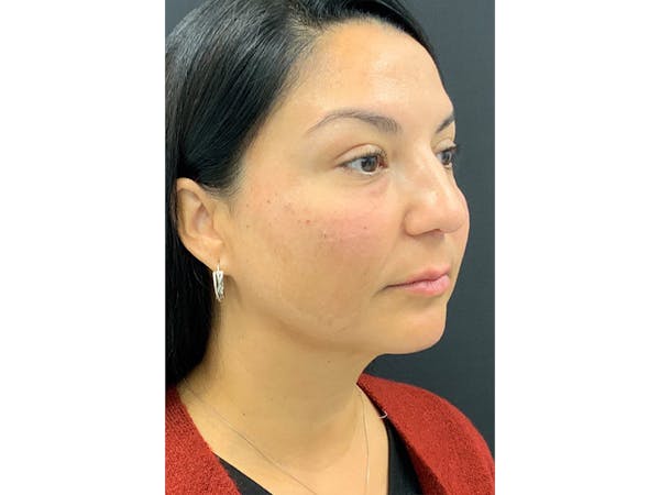 Filler Injections for Face Before & After Gallery - Patient 16689080 - Image 4