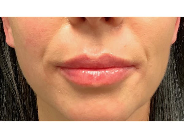 Filler Injections for Face Before & After Gallery - Patient 16689082 - Image 2