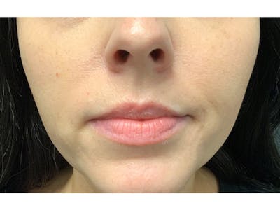 Filler Injections for Face Before & After Gallery - Patient 16689084 - Image 1