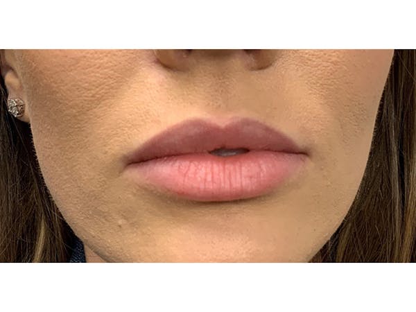 Filler Injections for Face Before & After Gallery - Patient 16689085 - Image 1