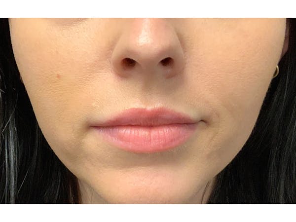 Filler Injections for Face Before & After Gallery - Patient 16689084 - Image 2