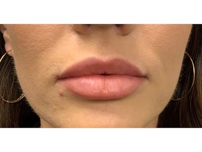 Filler Injections for Face Before & After Gallery - Patient 16689085 - Image 2