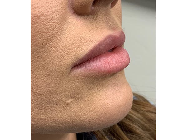 Filler Injections for Face Before & After Gallery - Patient 16689085 - Image 3