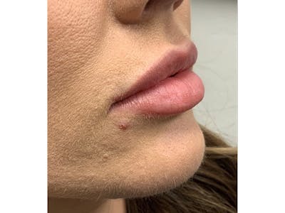 Filler Injections for Face Before & After Gallery - Patient 16689085 - Image 4