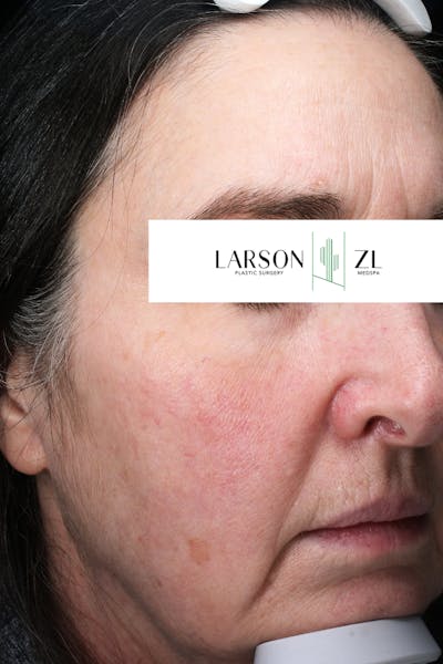 Laser Before & After Gallery - Patient 140819522 - Image 1