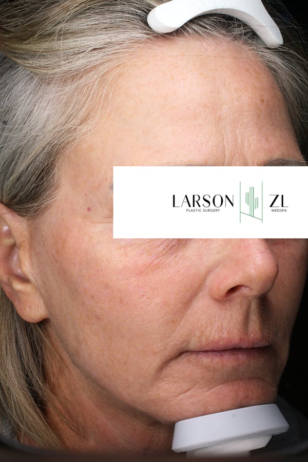 Laser Before & After Gallery - Patient 140819523 - Image 2