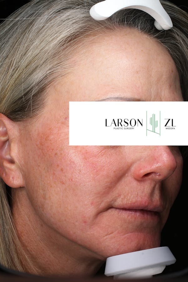 Laser Before & After Gallery - Patient 140819523 - Image 1