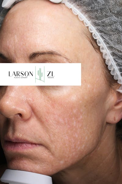 Laser Before & After Gallery - Patient 140819524 - Image 2
