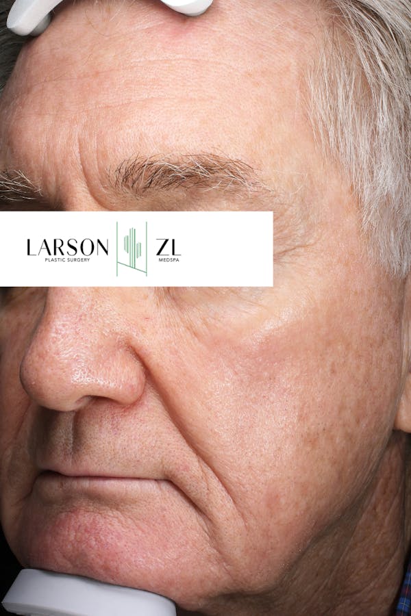 Laser Before & After Gallery - Patient 140819525 - Image 2