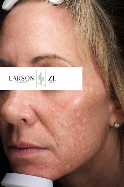 Laser Before & After Gallery - Patient 140819524 - Image 1