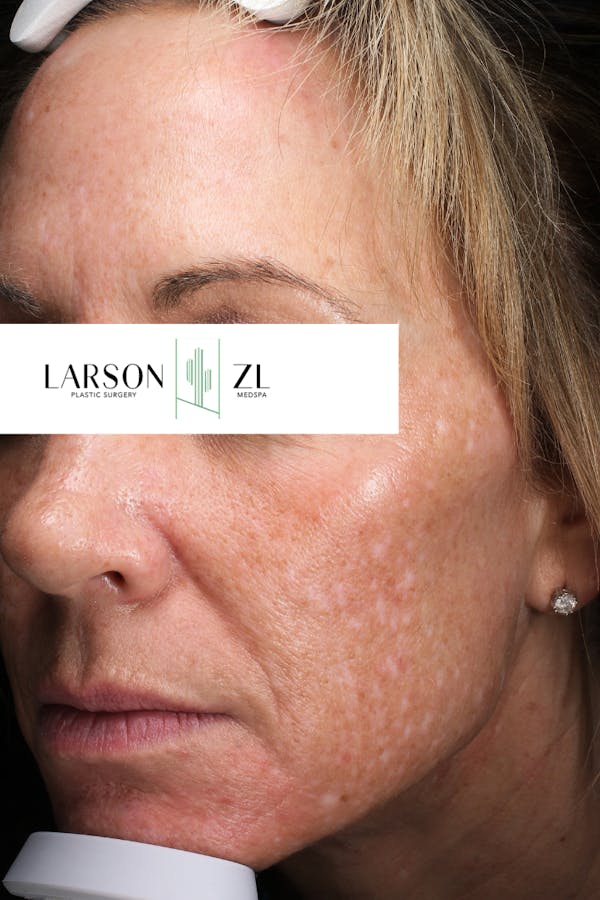Laser Before & After Gallery - Patient 140819524 - Image 1