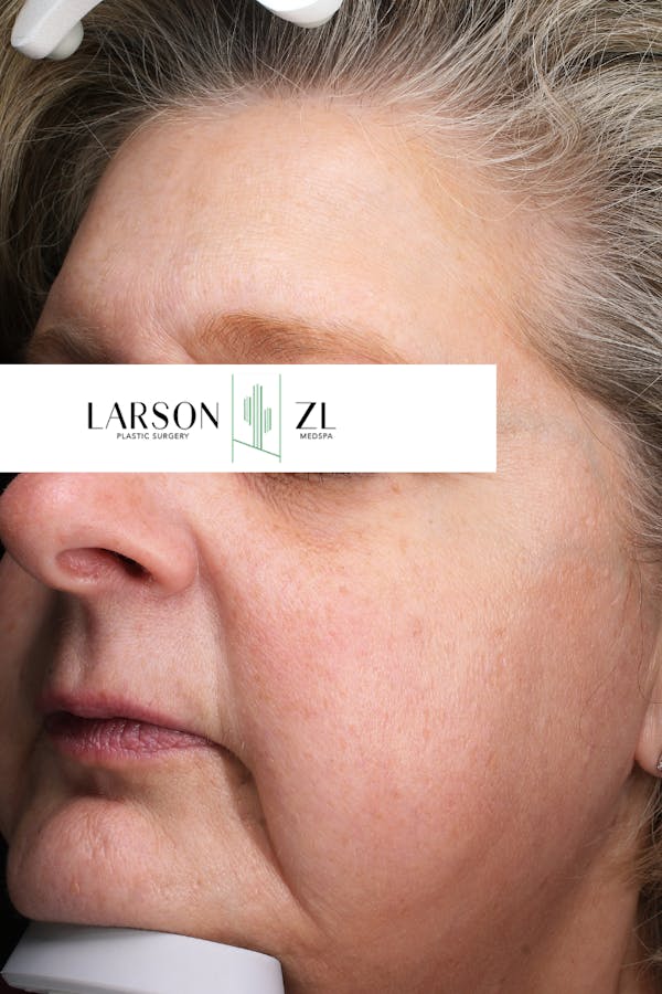 Laser Before & After Gallery - Patient 140819527 - Image 2