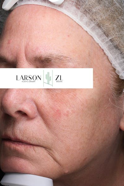 Laser Before & After Gallery - Patient 140819528 - Image 2