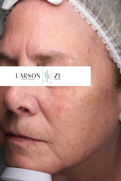 Laser Before & After Gallery - Patient 140819528 - Image 1