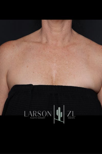 Laser Before & After Gallery - Patient 140819529 - Image 2