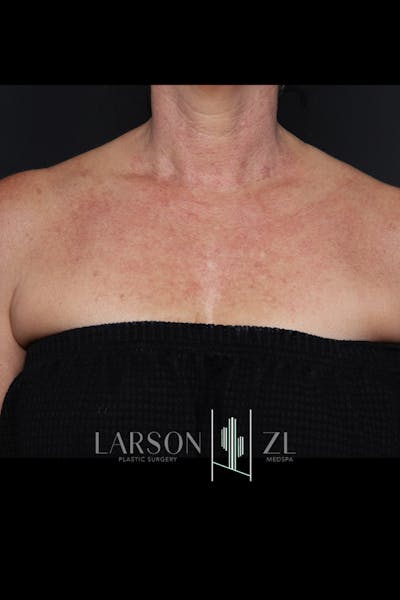 Laser Before & After Gallery - Patient 140819529 - Image 1