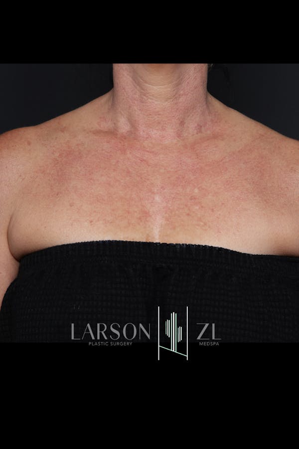 Laser Before & After Gallery - Patient 140819529 - Image 1