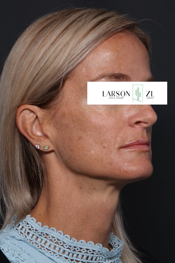 Laser Before & After Gallery - Patient 140819530 - Image 2