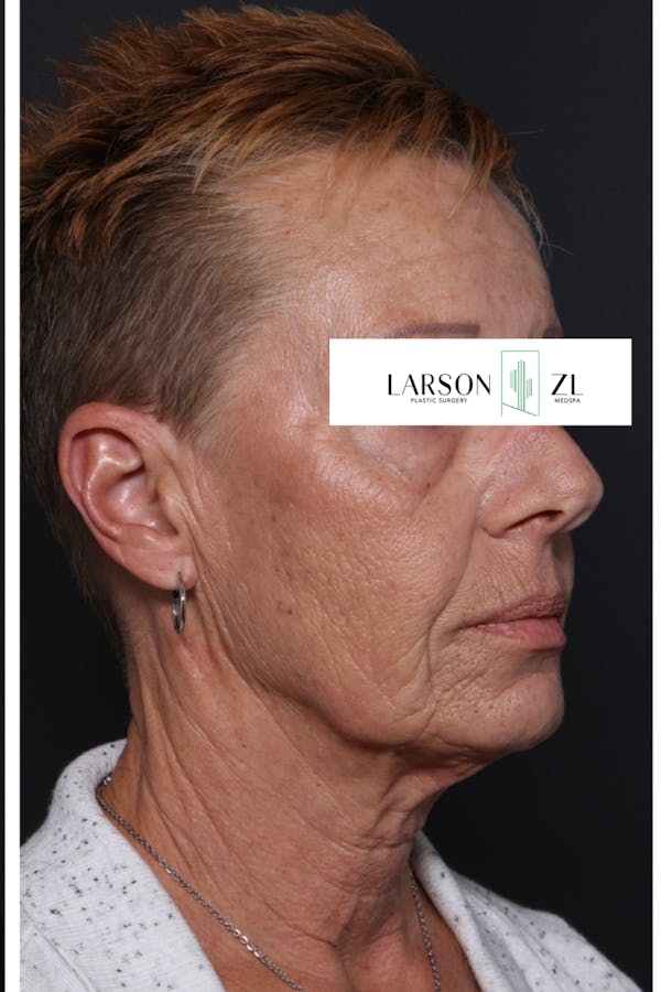 Laser Before & After Gallery - Patient 140819531 - Image 2