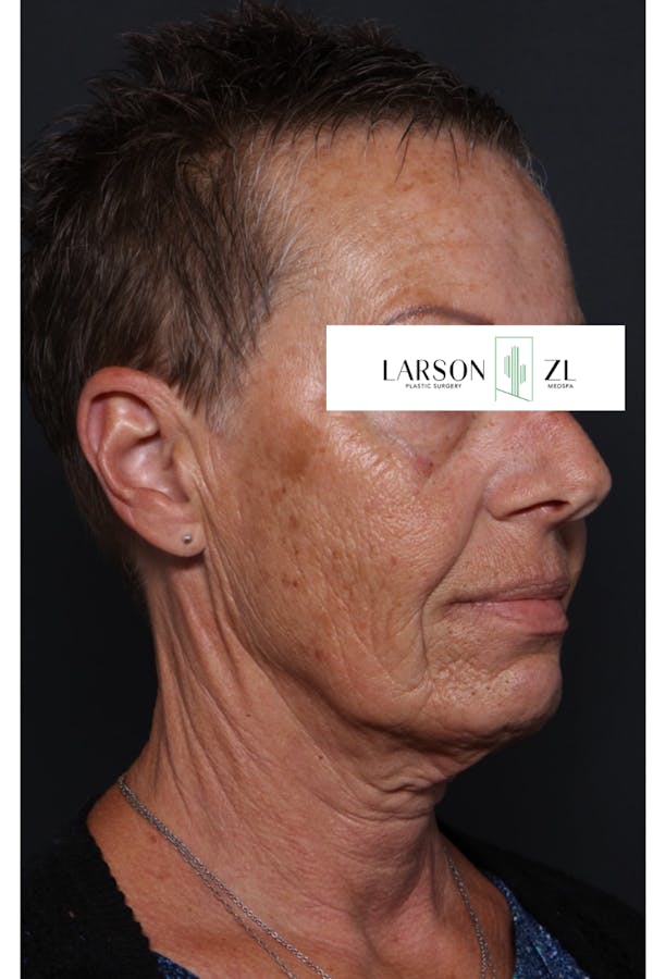 Laser Before & After Gallery - Patient 140819531 - Image 1