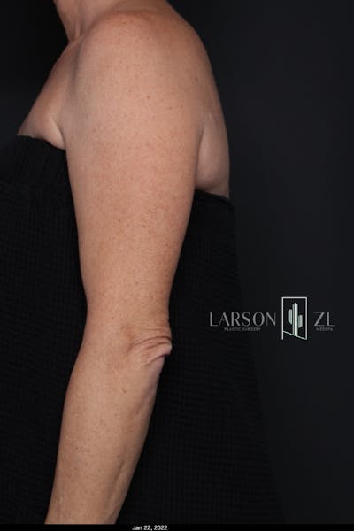 Laser Before & After Gallery - Patient 140819532 - Image 1