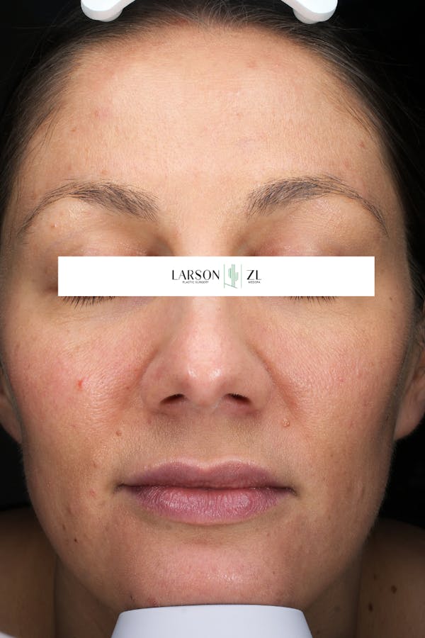 Laser Before & After Gallery - Patient 140819534 - Image 2